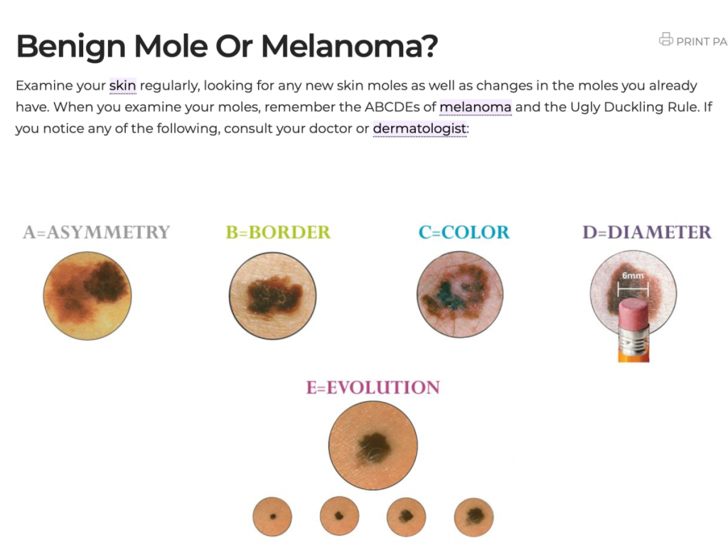 Melanoma Mole